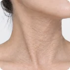 Crepey neck with fine, dense wrinkles