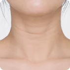 Horizontal neck wrinkles
