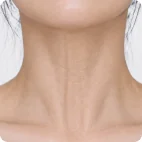 Vertical neck wrinkles and platysma bands